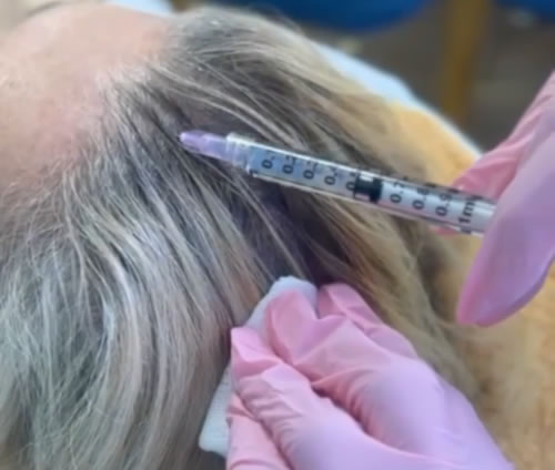 Terapia de choque capilar